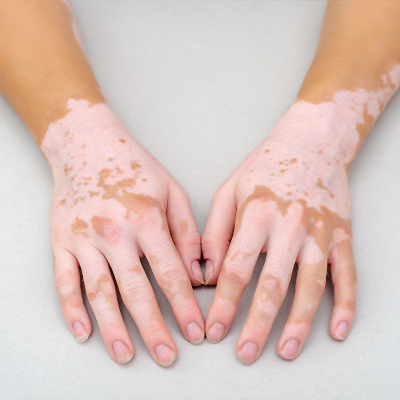 Manage Vitiligo