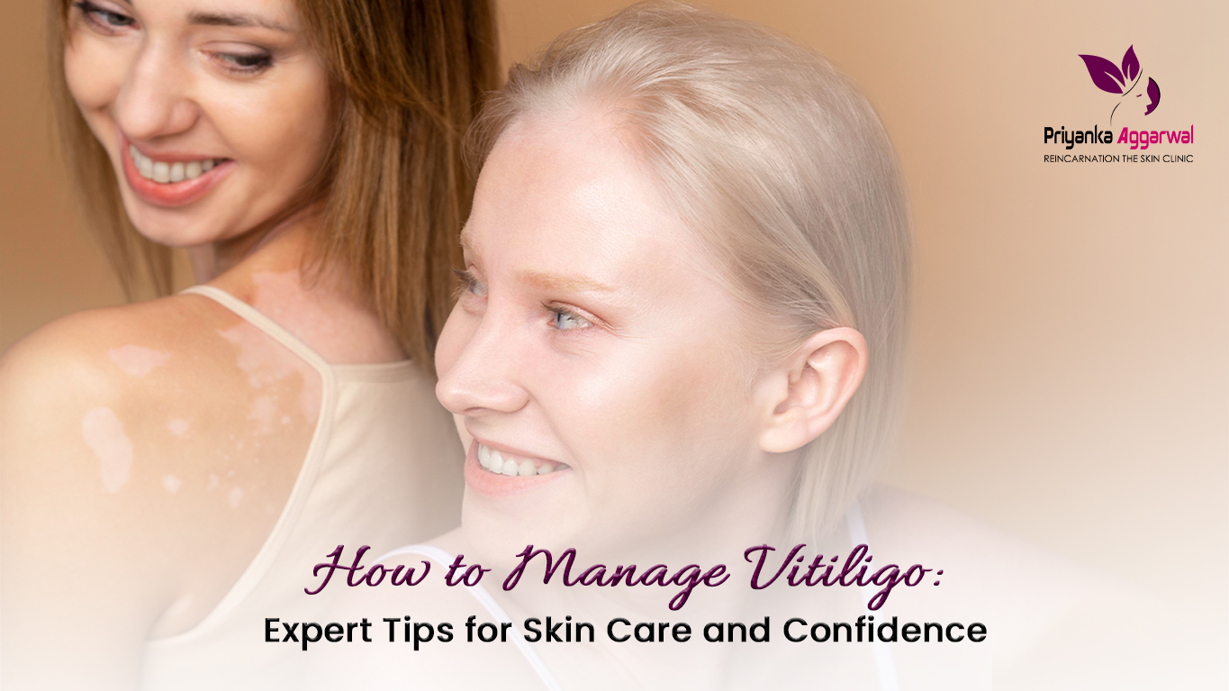 Manage Vitiligo