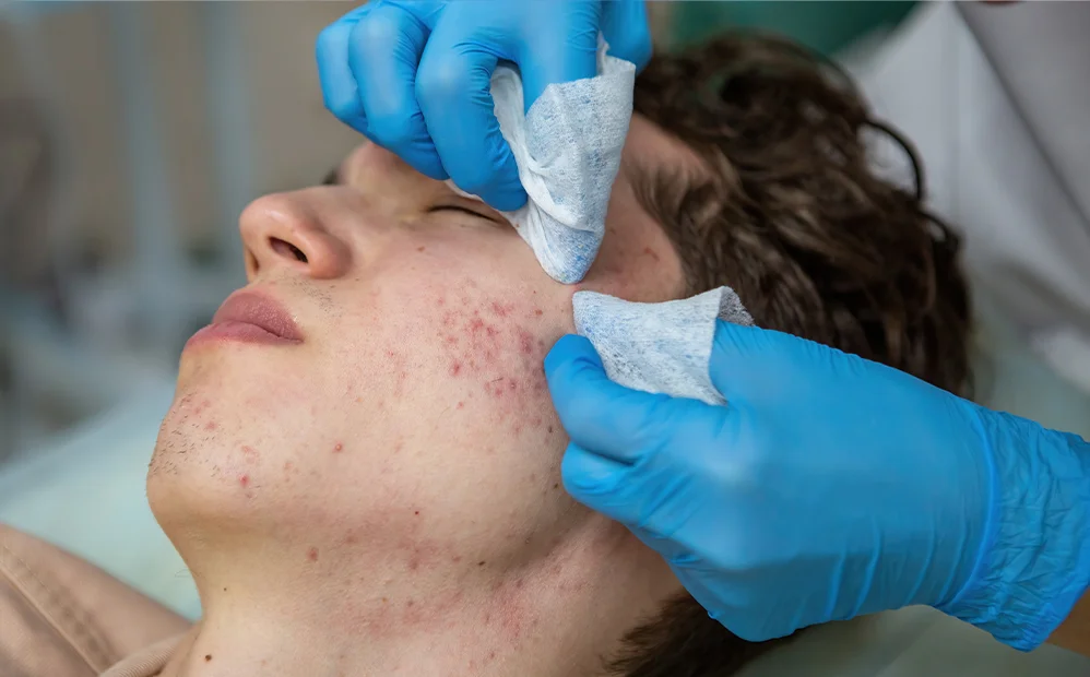 acne treatment clinic