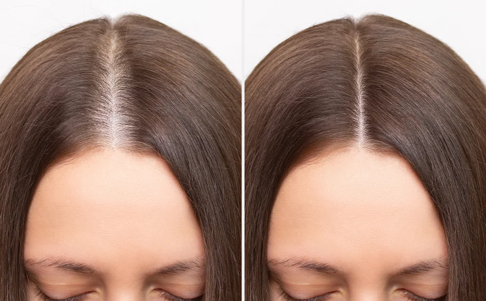 Hair fall treatment