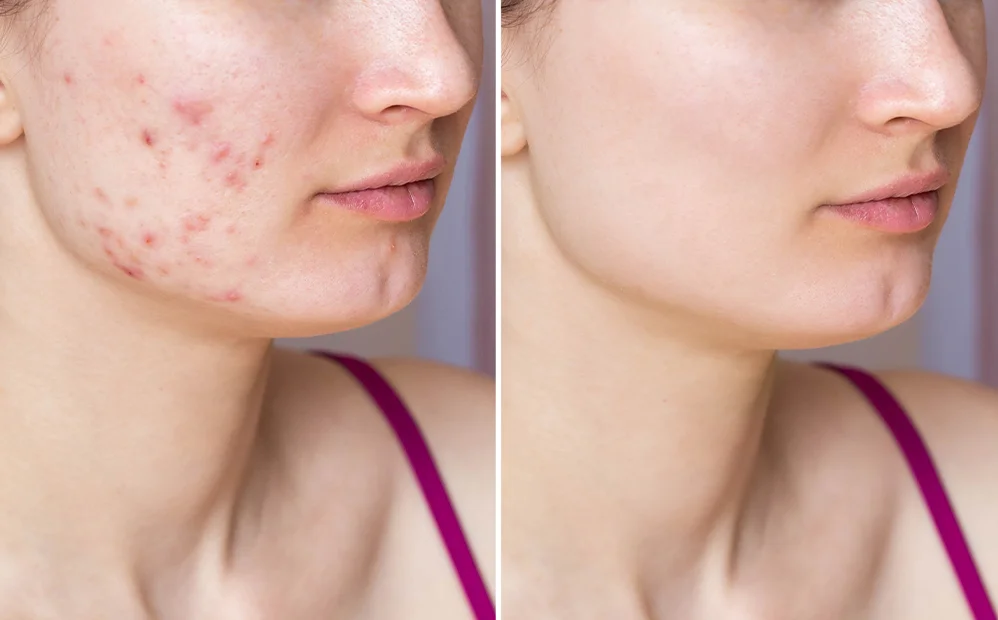 Acne Solutions