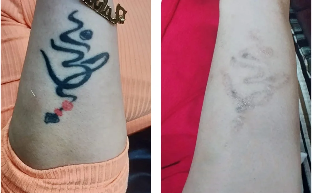 Tattoo Removal Treatment