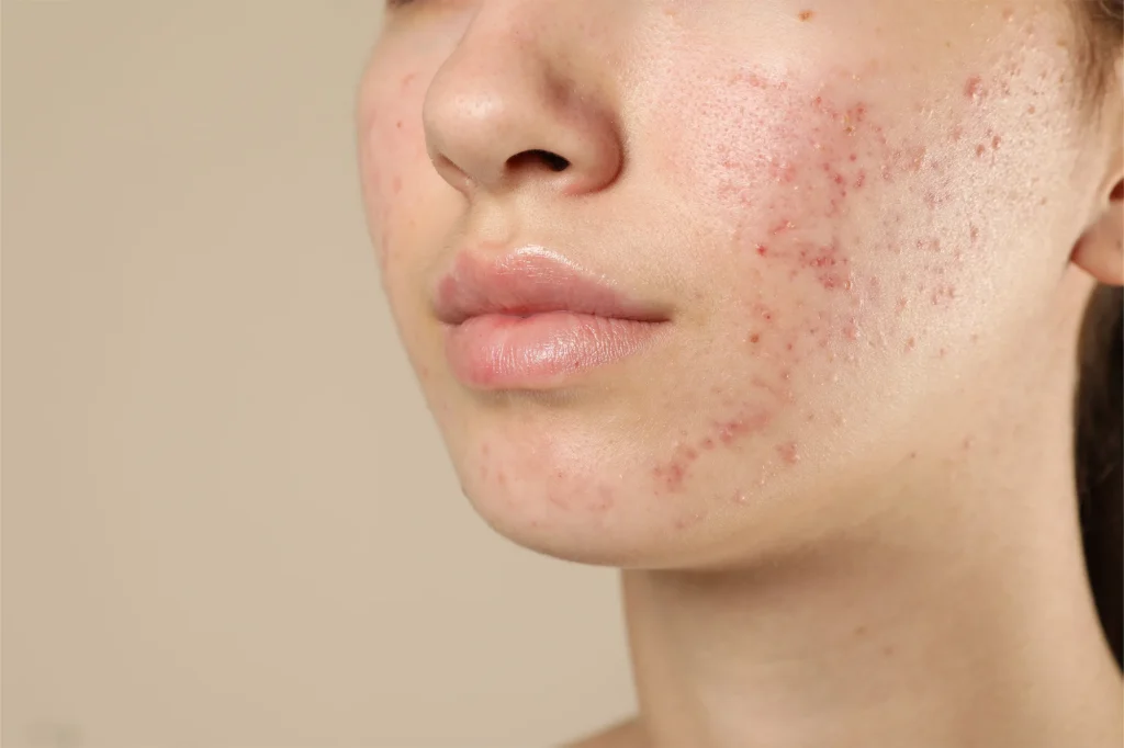 Acne Treatment