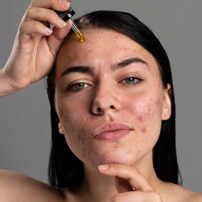 acne treatment at home