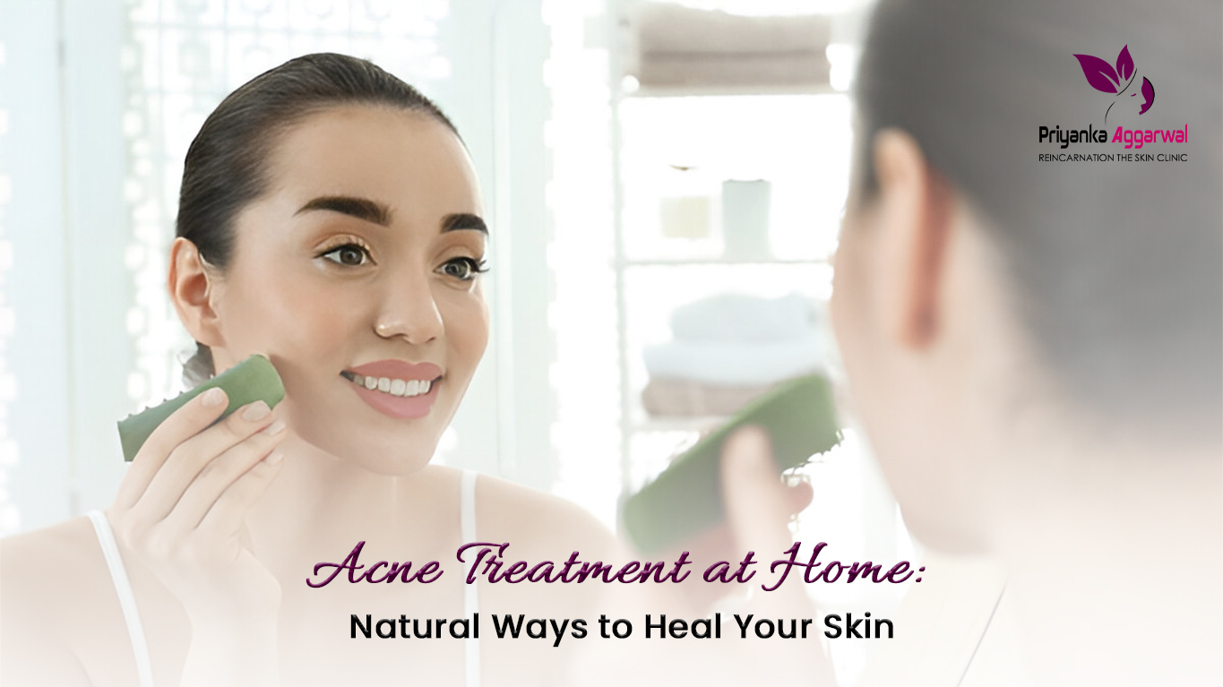 acne treatment at home